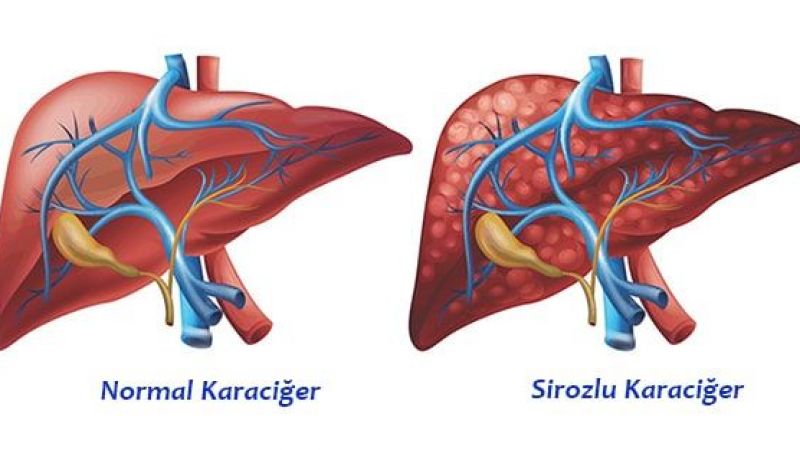 Siroz Hastalığı Nedir? 3