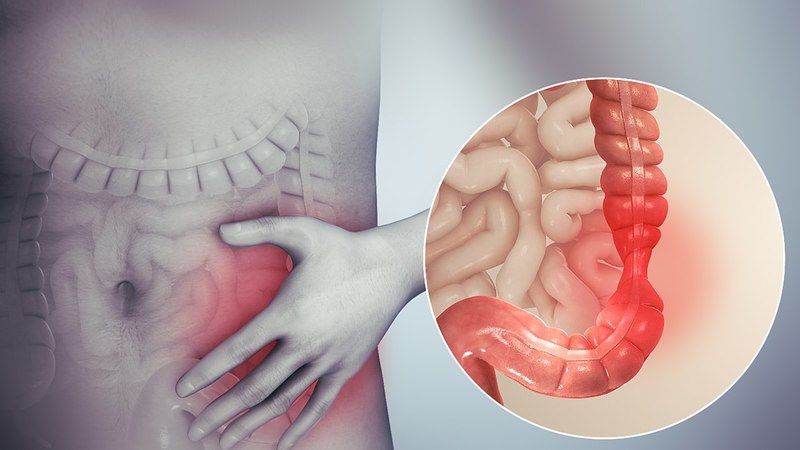 İrritabl Bağırsak Sendromu Nedir? Nedenleri, Belirtileri, Tedavisi, Testi 1