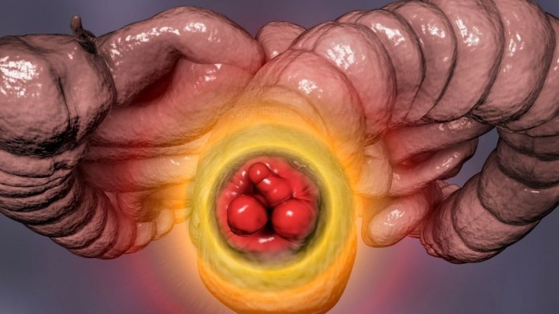 Uzman İsim Açıkladı! Hemoroid’in Nedenleri ve Korunma Yolları! Beslenmeye Dikkat! 2