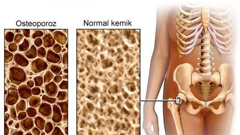 Menopoza bağlı kemik erimesi olan kadınlar, mutlaka şalgam tüketmeli! Çocuklarda kemik gelişimi de destekliyor: İştahı açıyor… 1