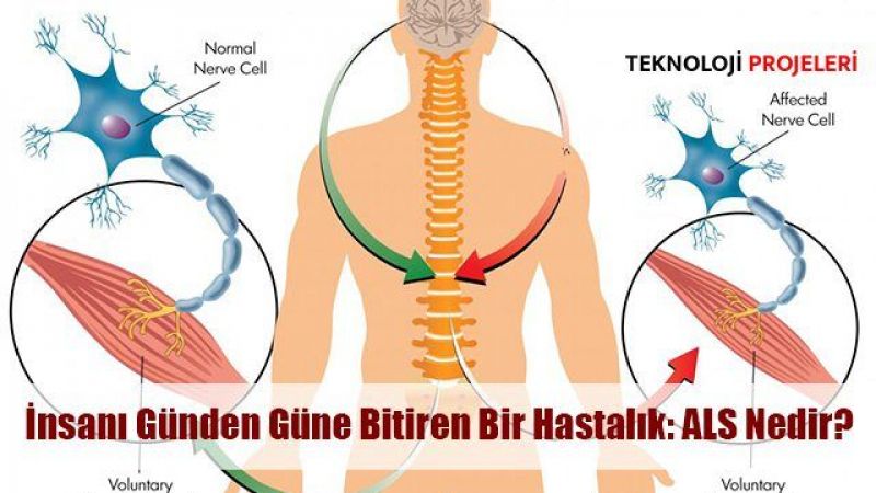 Stephan Hawking’in Senelerce Mücadelesini Verdiği ALS Hastalığı Nedir? ALS Nasıl Ortaya Çıkar? 3