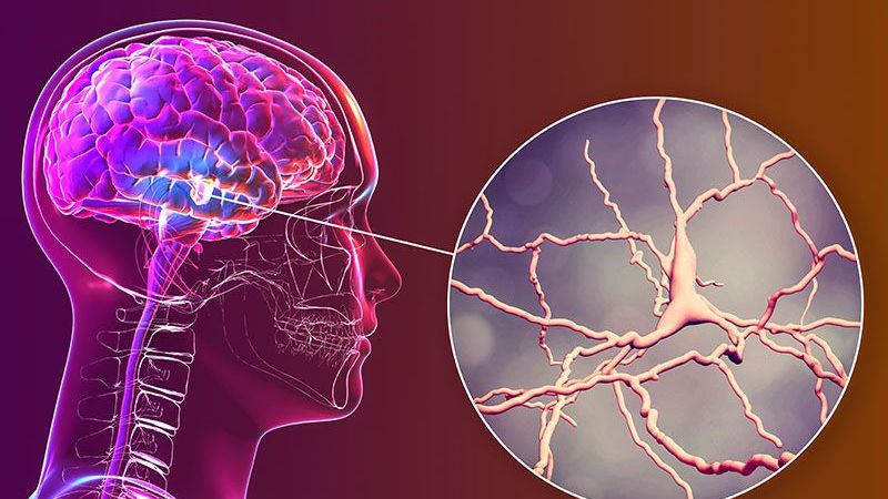 Bu Belirtilere Dikkat! Parkinson Hastalığının 10 Sene Önce Bu Belirtiler İle İşaret Verdiği Ortaya Çıktı! 1