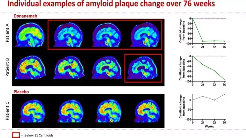 Alzheimer Hastaları İçin Umut Verici Gelişme! Hastalığın 3’te 1 Oranında Seyrini Değiştirecek İlaç! 2