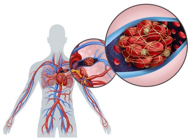 Akciğer Embolisi ve Belirtileri! Akciğer Embolisine Neden Olan Faktörler! 1