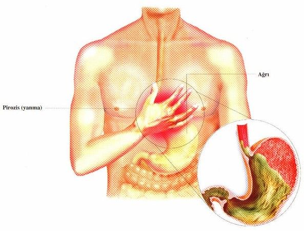 Türkiye’de Her 4 Kişiden 1’i Bu Şikâyetten Yakınıyor! Reflüde Tedavi Yolları! 2
