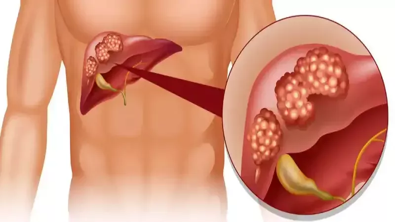 Karaciğer Kanseri İçin Erken Uyarıcı Niteliğinde! Bu 3 Semptomu Dikkate Alın! 1