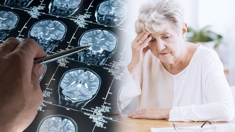 Türkiye Alzheimer hastalığının en sık görüldüğü 4. ülke! Hastalığın belirtileri nelerdir? 4