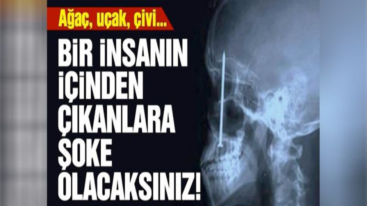 İnsanların içinden çıkarılmış en garip nesneler