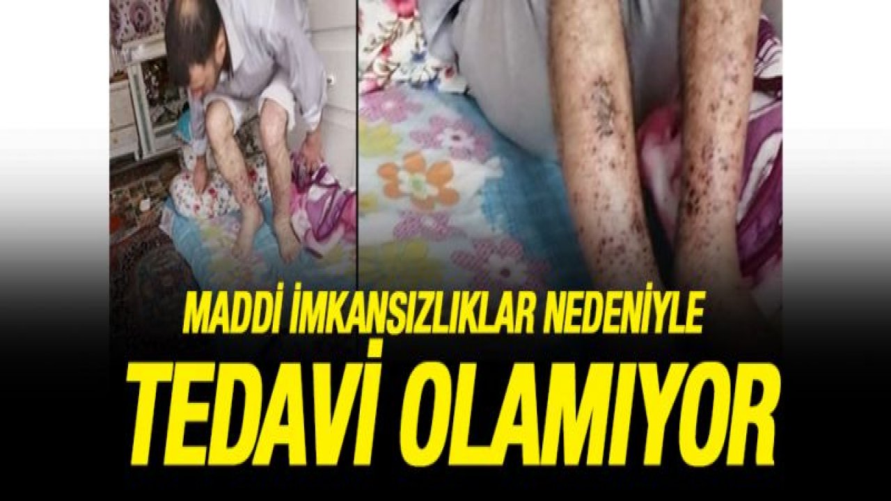 Ayakları enfeksiyon kapan vatandaş, maddi imkansızlıklar nedeniyle tedavi olamıyor