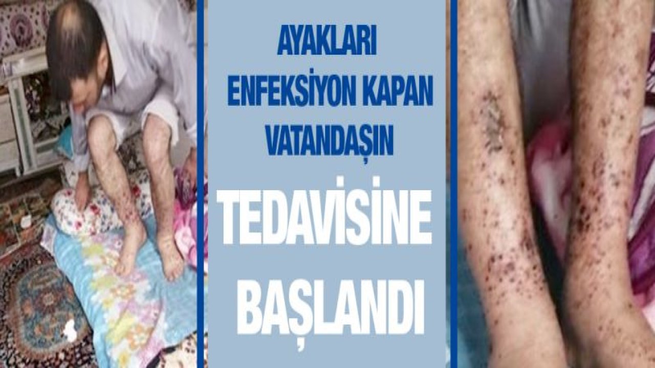 Ayakları enfeksiyon kapan vatandaşın tedavisine başlandı