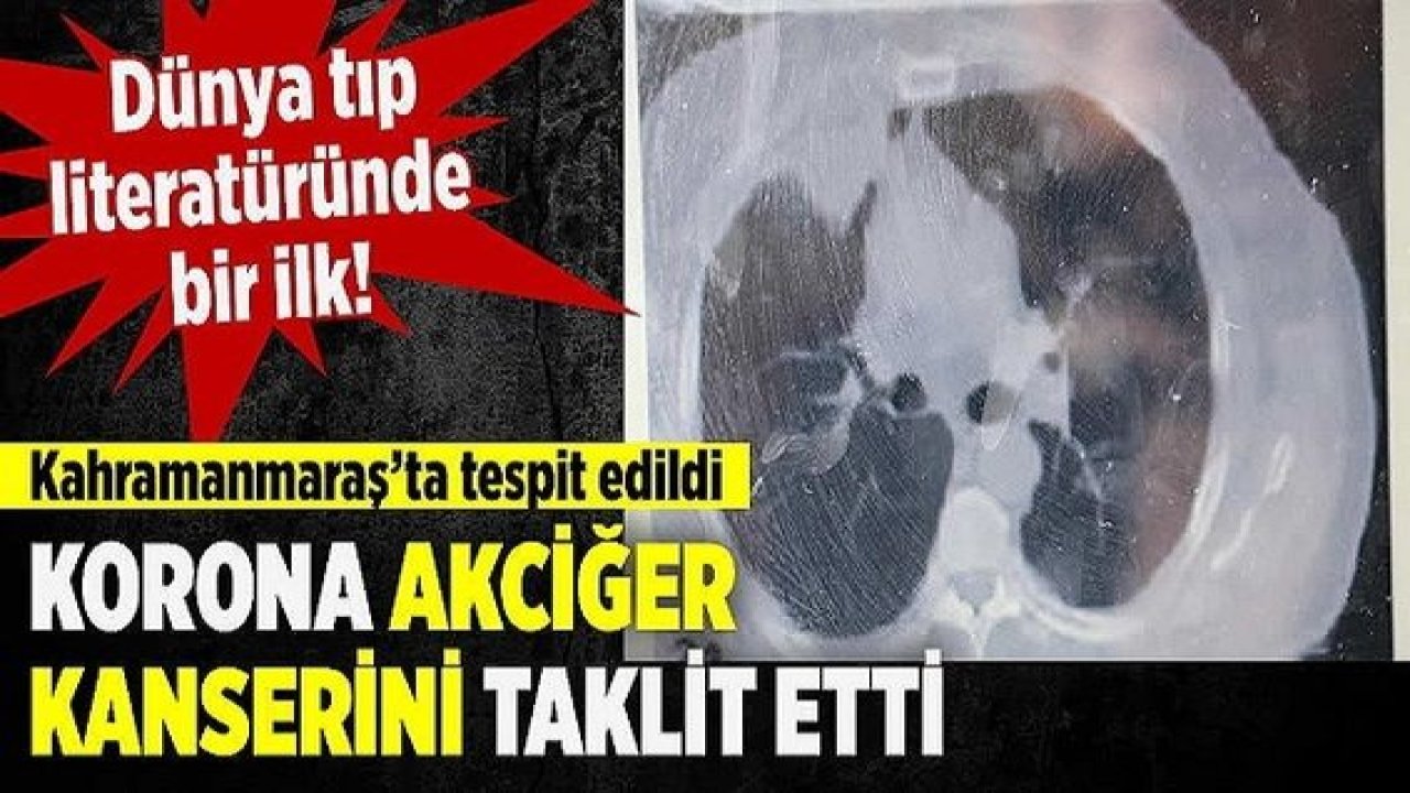 Son Dakika:Koronada Bir İlk Kahramanmaraş'ta tespit edildi: Koronanın, akciğer kanserini taklit ettiği ortaya çıktı