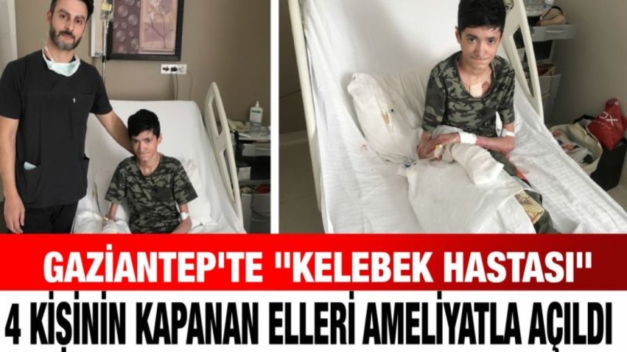 Gaziantep'te "kelebek hastası" 4 kişinin kapanan elleri ameliyatla açıldı