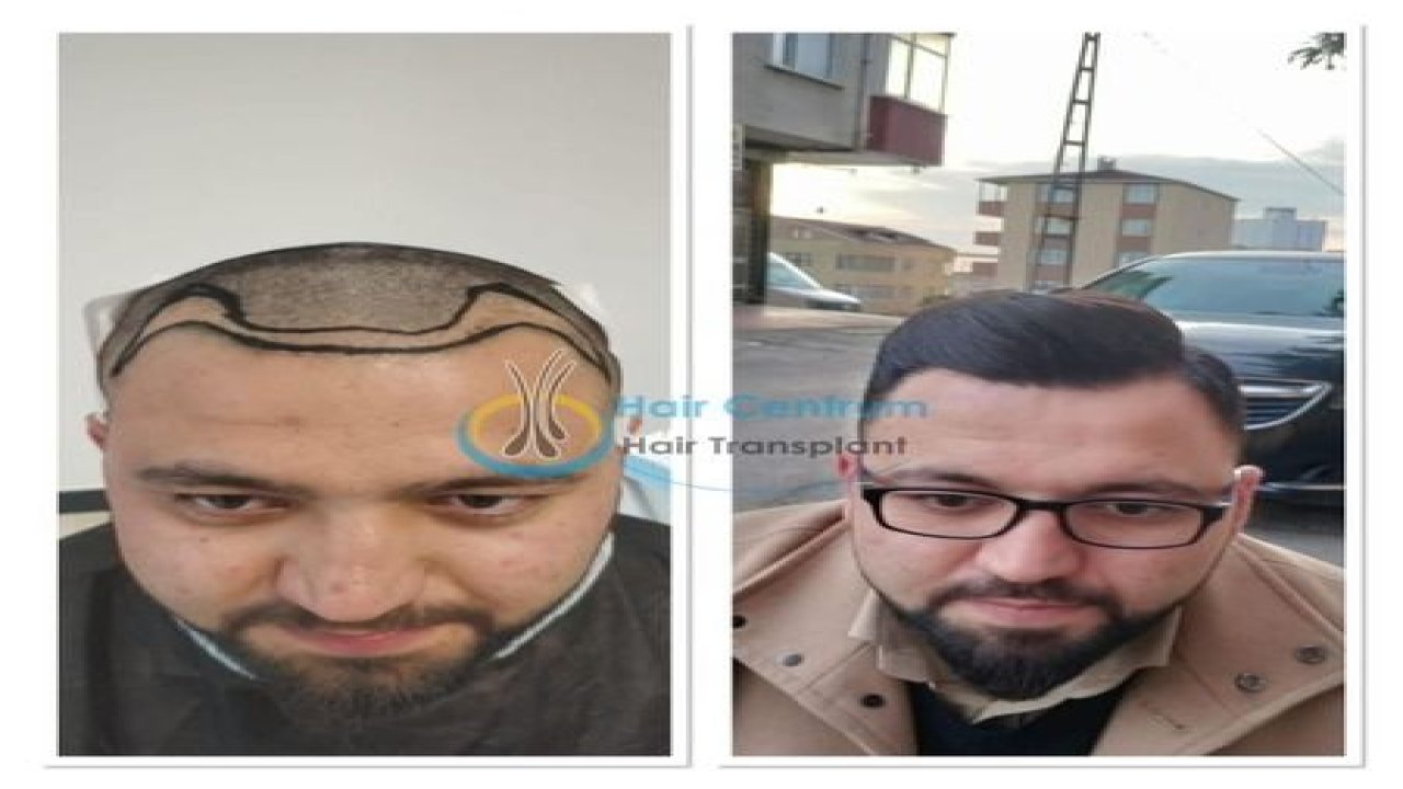 HairCentrum ile Ağrısız Acısız Saç Ekimi Deneyimi