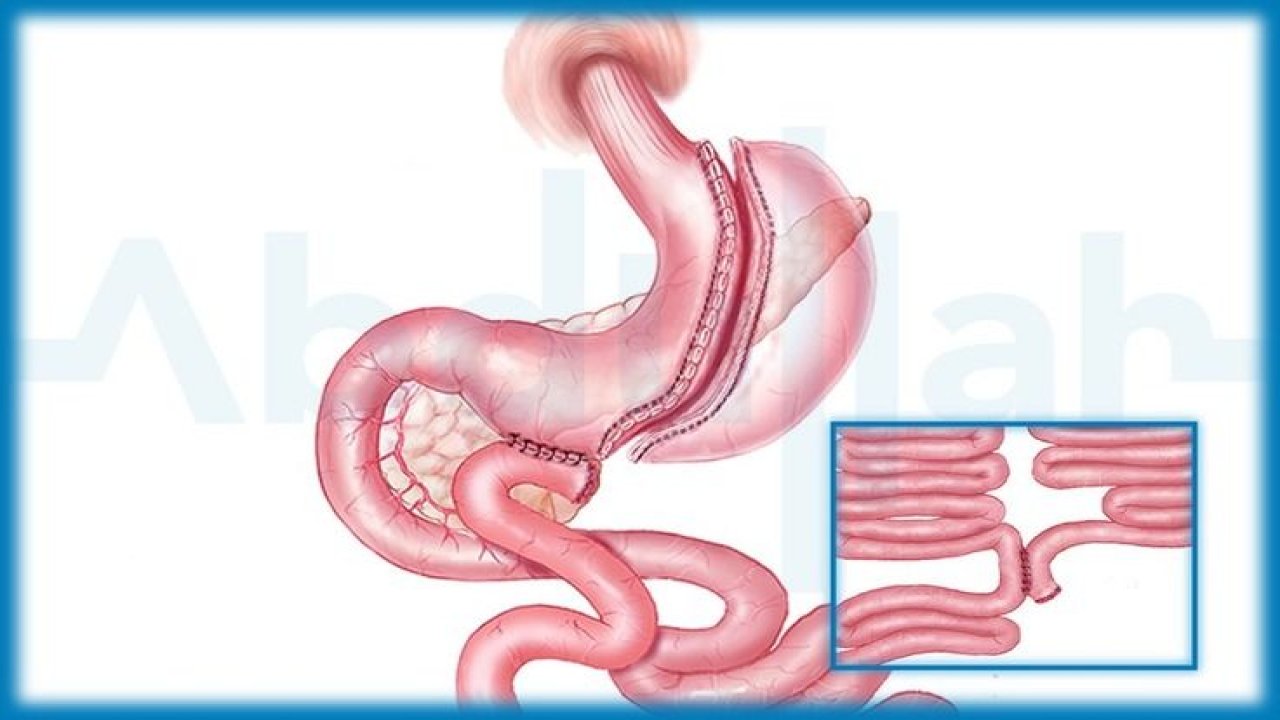 RNY Gastrik Bypass Ameliyatı Obezite İçin Kullanılıyor