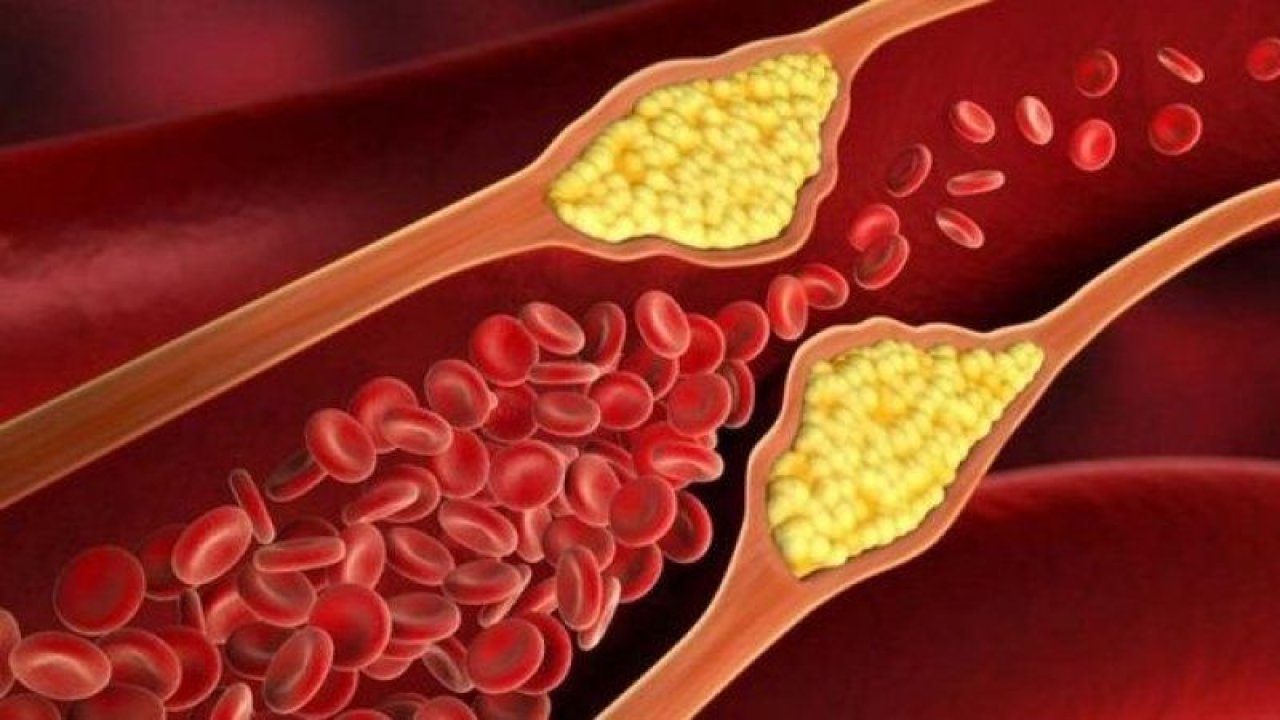 Yüksek Kolesterolü Dengelemenin Yolları! Uzak Durulması Gereken Gıdalar!