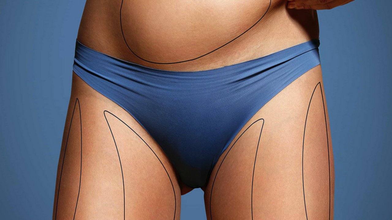 Liposuction Nedir? Ne Yapılır?